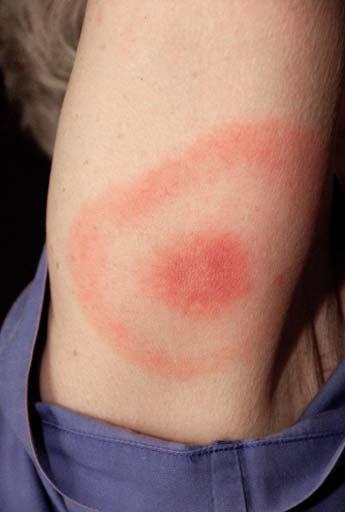 Lyme Disease: Clinical Manifestations Characteristic bulls-eye rash (erythema migrans, EM) Only 70 80% patients