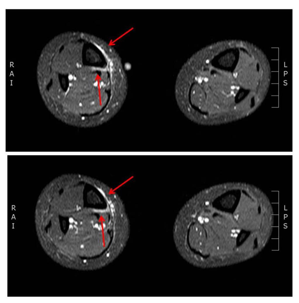 Fig. 4: Axial fat-suppressed T2-weighted fast spin-echo image shows moderate