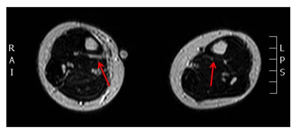 Fig. 5: The corresponding axial T2-weighted fast spin-echo image.