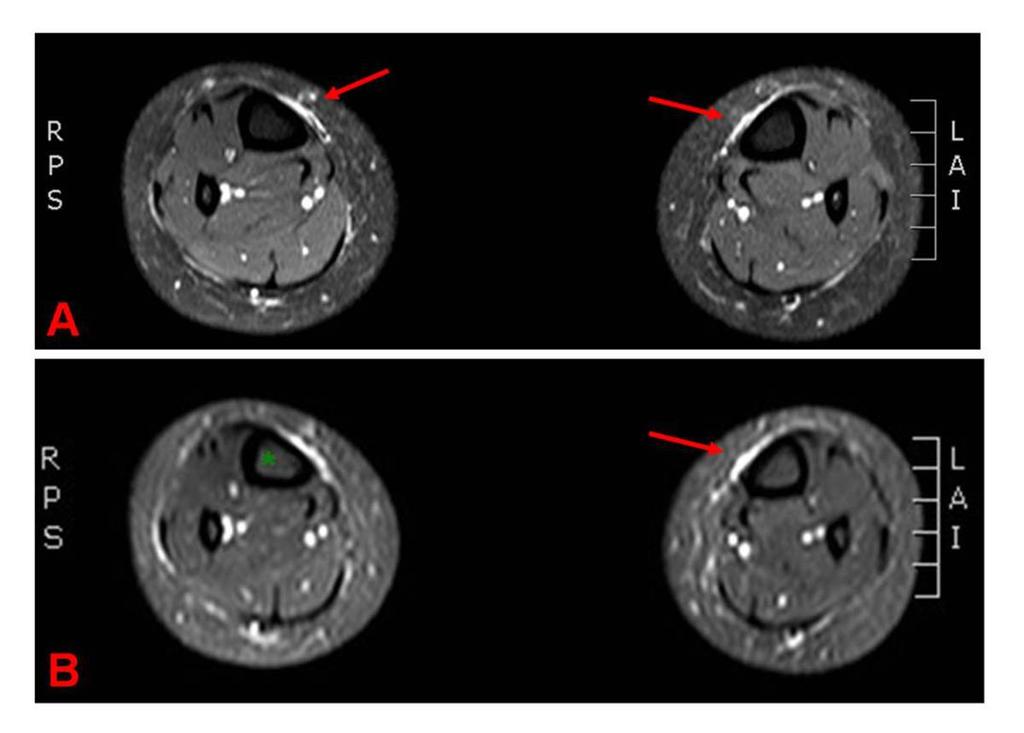 Images for this section: Fig. 1: A 24 year old female complaining of bilateral tibial pain. A. Fat-suppressed T2- weighted fast spin-echo images show mild periosteal edema (arrows) on medial cortex of mid tibial diaphysis.