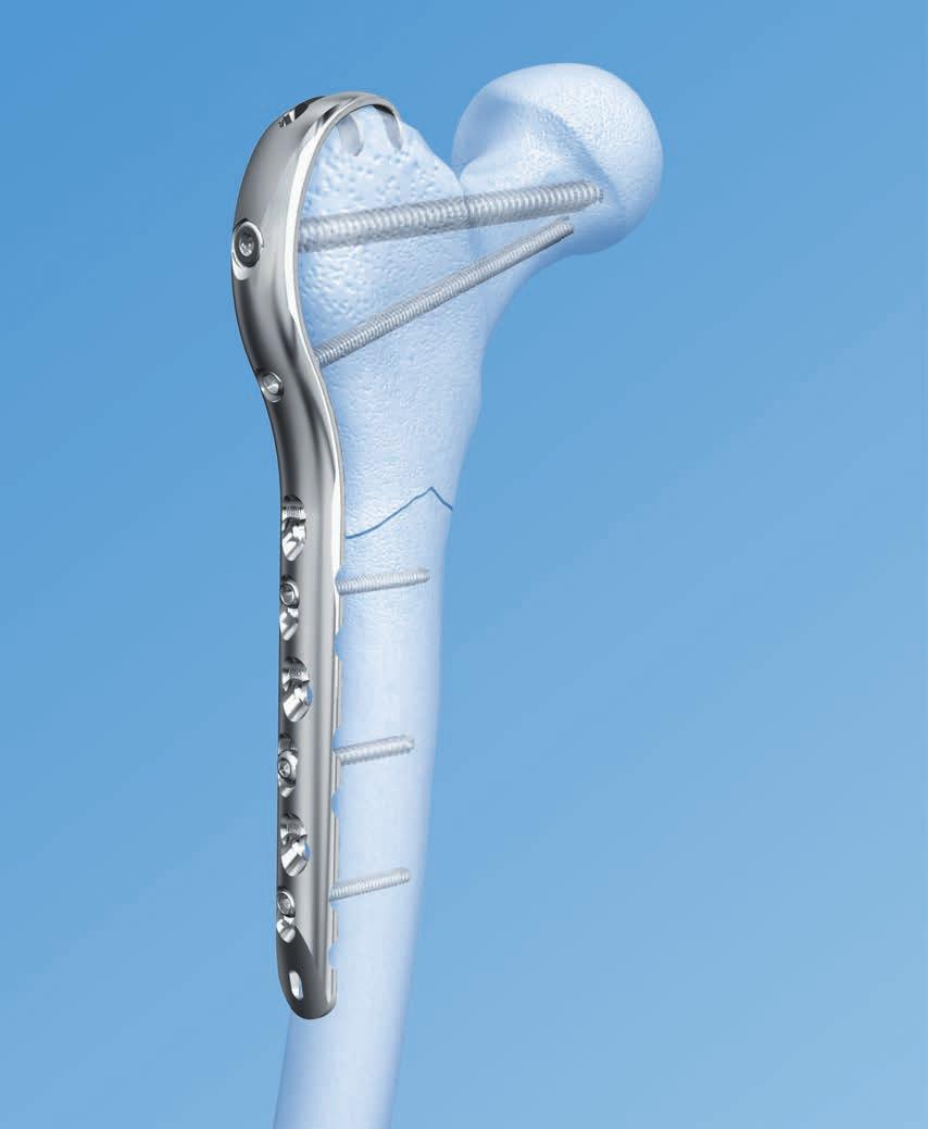 LCP Proximal Femoral Hook Plate 4.5/5.0. Part of the LCP Periarticular Plating System.