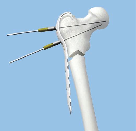 Using fluoroscopic image control (AP and lateral), insert a guide wire B 2.5 mm through the wire guide in each of the proximal locking holes.