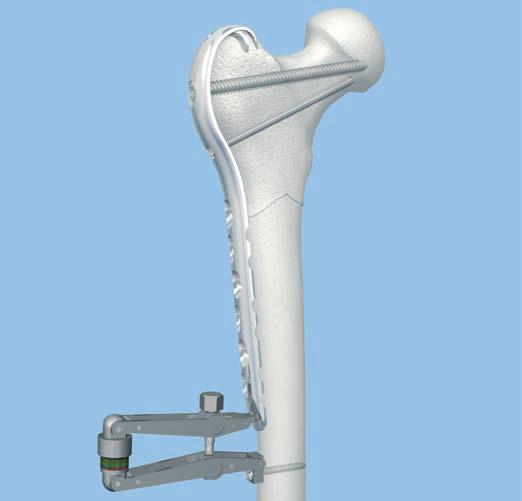 6 Approximate plate to femoral diaphysis Instrument 321.