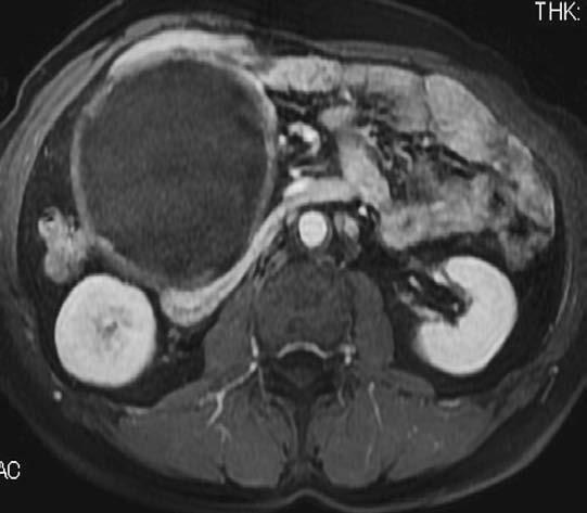A Case of Giant Mesenteric Cystic Cyst 127 Fig. 4.