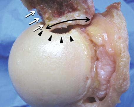 engagement as defined by the glenoid track concept correspond to failure of primary arthroscopic capsulolabral stabilization?