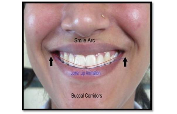 The multiple comparsions : Tukey HSD test revealed that tooth arc and lip arc in significantly greater in group A to group c. (p<.001).