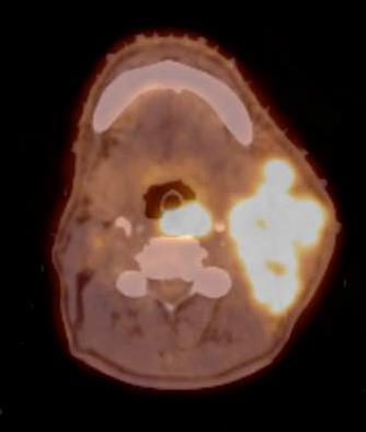 11/2014 PET CT Large L sided cervical mass Periepiglottic tumor with no airway compromise Multiple