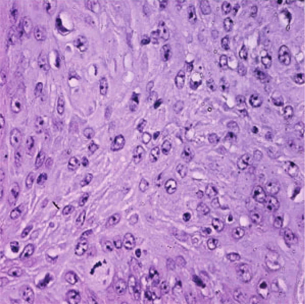 4 Case Reports in Neurological Medicine Figure 3: Malignant squamous cell carcinoma arising from the epidermal cyst, with mitotic activity and cellular atypia (hematoxylin and eosin, original