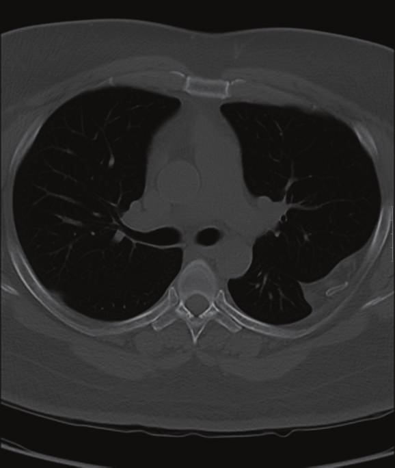 4 Figure 5: 43-year-old gentleman complaining of high grade fever, cough, and chest pain was investigated with chest radiographs and helical chest CT scan and subsequently diagnosed with
