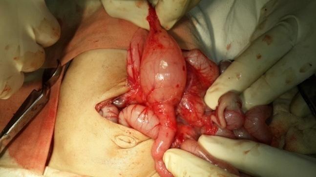 12(3.8%), Meconium disease of newborn in 9(2.85%) while colonic atresia was seen in one (0.3%) patient.