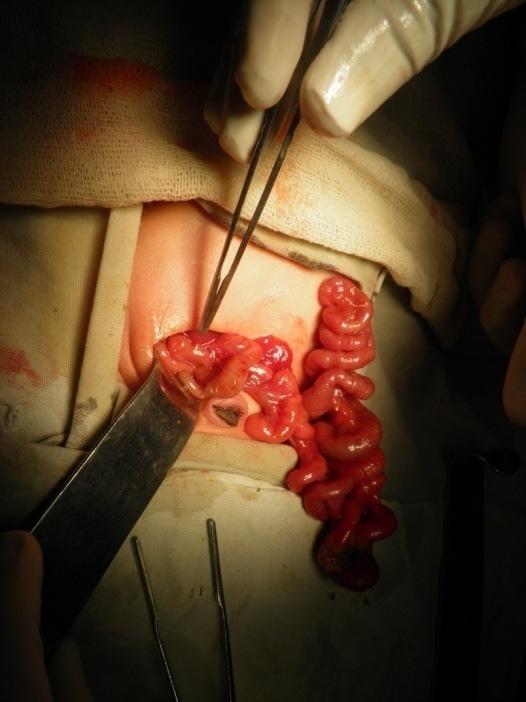 and preparation. Colostomy was performed in 145(45.88%) patients out of which 103 were right transverse loop colostomies and 42 sigmoid loop colostomies. Pouchostomy was done in 15(4.