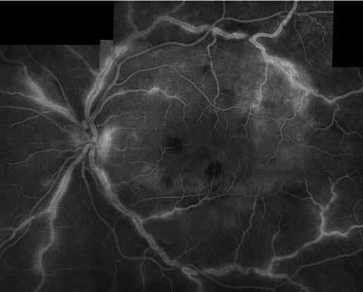 () Low power view showing nodular sclerosis pattern (hematoxylin and eosin, x25).