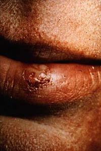 source: http://www.moondragon.org/images/coldsore.jpg Another sign of an HSV infection is the formation of genital herpes caused mostly by HSV-2.