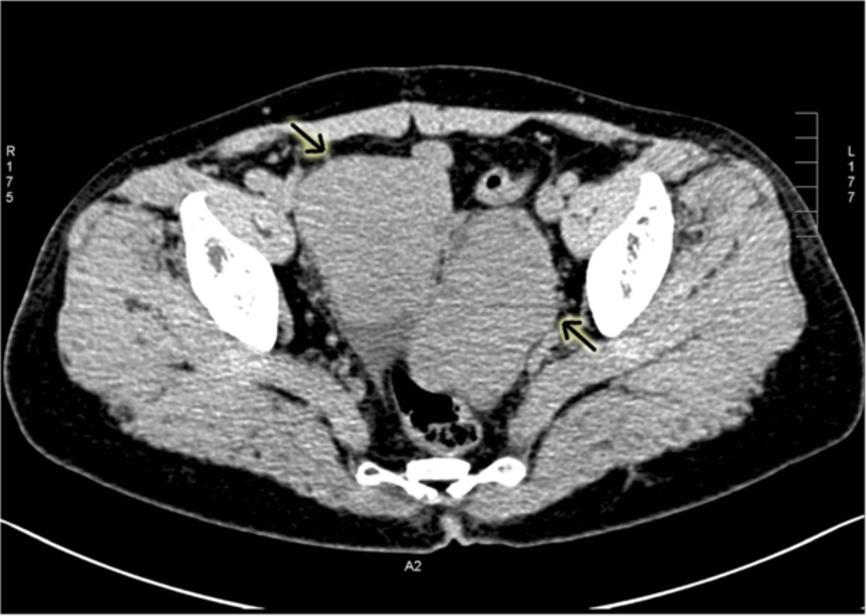 Wang et al. World Journal of Surgical Oncology 2013, 11:29 Page 2 of 5 Figure 1 Abdominal CT scans in the patient.
