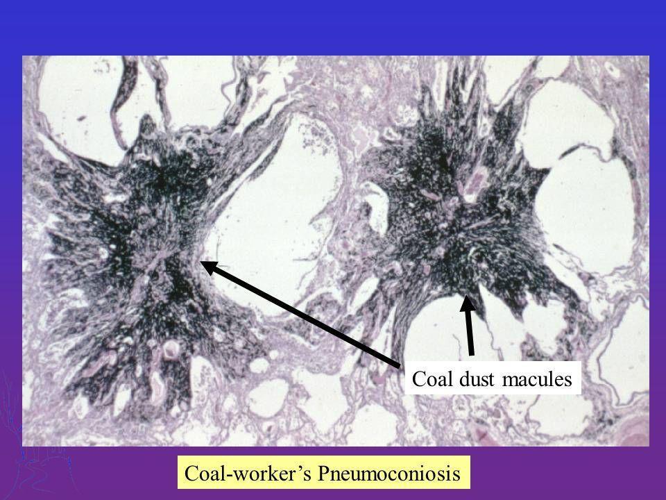 If the macules are large they are called coal nodules.