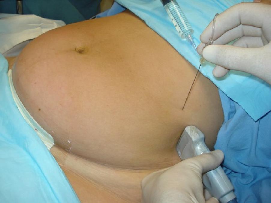 Figure (1): Using strict aseptic technique, the ultrasound probe was covered by a sterile plastic cover and placed in the midaxillary line just superior to the iliac crest.