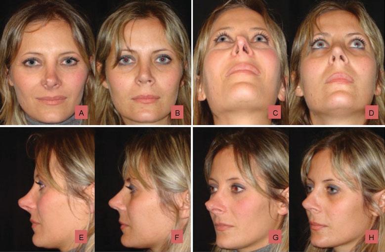 Dome Division Boccieri et al. 669 Fig. 5 (A, C, E, G) Preoperative views of woman patient showing overprojection with asymetrical tip. (B, D, F, H) One year after the operation.