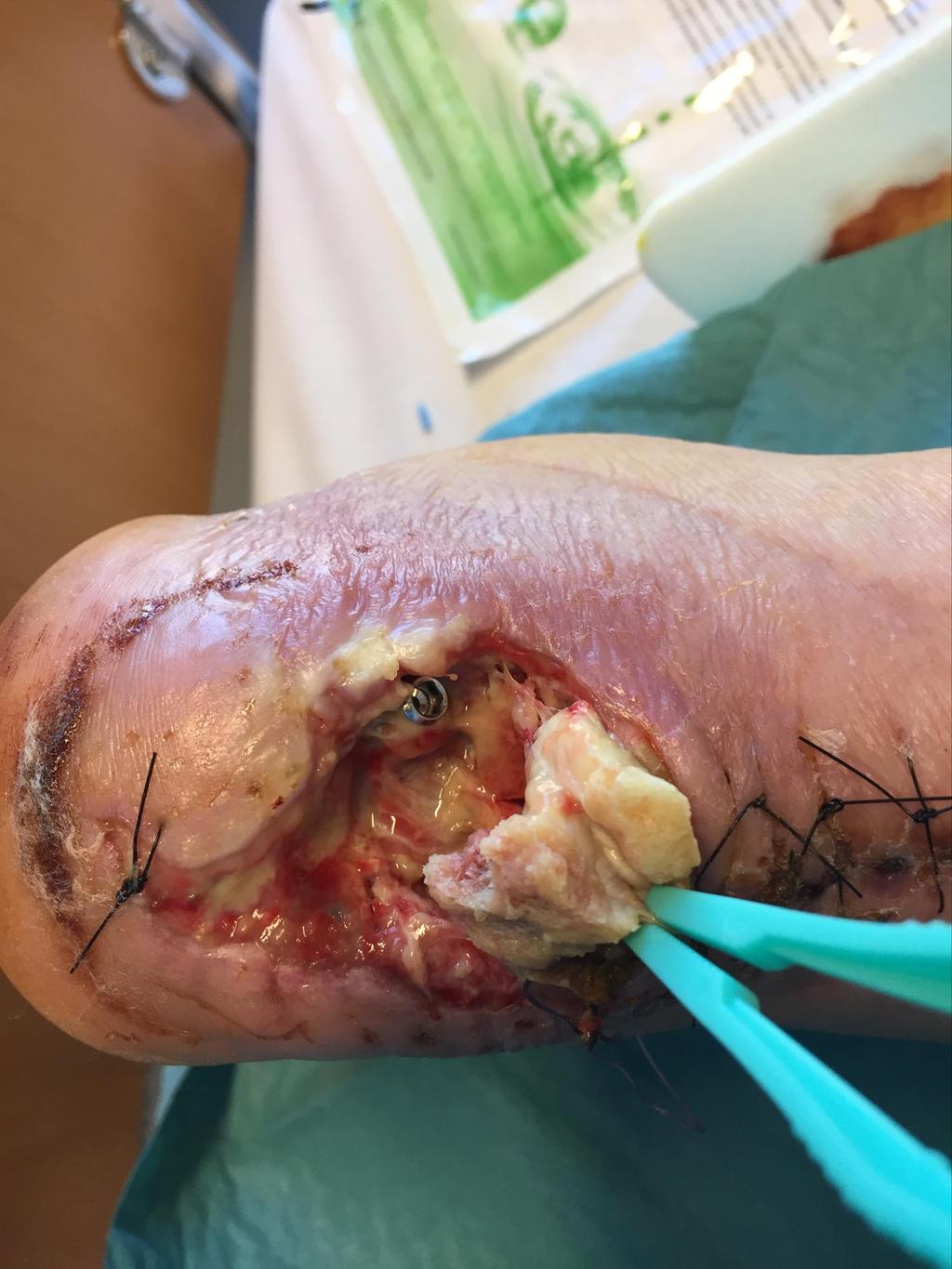 65 year old man Infected calcaneus fixation