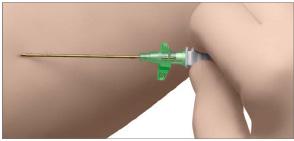 indwelling catheter As easy as the single shot technique Outstanding reflection properties due to Cornerstone reflectors and SelfPriming system Double safety thanks to