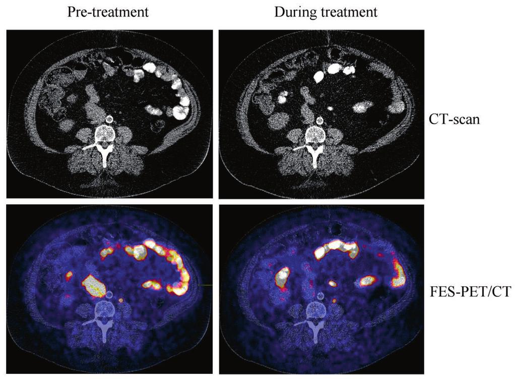 Pre-treatment During treatment CT-scan Chapter 3A FES-PET/CT Figure 2.