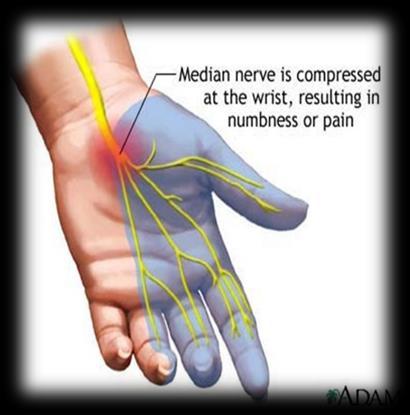 percuss the transverse carpal ligament over the median nerve where the patient palm