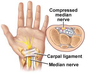 if flexing the patient wrist cause pain or numbness in his hand or finger,he has