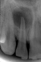 Some general observations Periapical Cyst Lesions above the mandibular canal are likely odontogenic