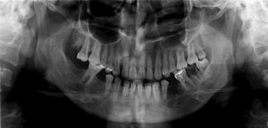 common in maxilla and potentially more mutilating Locally