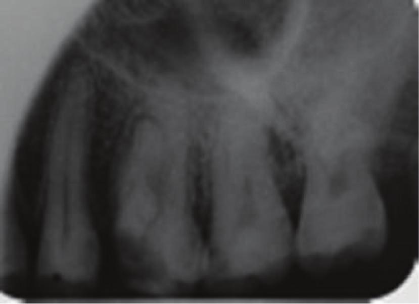 2 Case Reports in Dentistry Figure 1: Preoperative radiograph. Figure 3: Pulp chamber floor after root canal preparation. Figure 2: Length-determination radiograph.