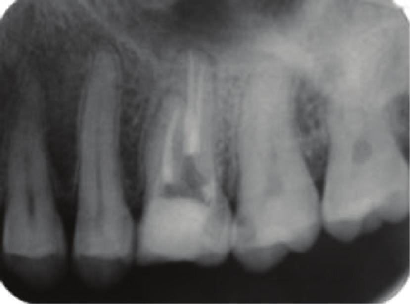 These findings led to a provisional diagnosis of pulp necrosis with chronic apical periodontitis of the right maxillary first molar, necessitating endodontic therapy.