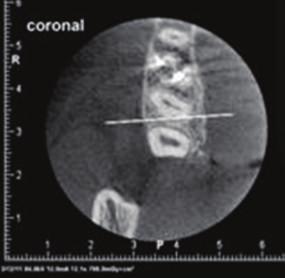 Case Reports in Dentistry 3 Figure 5: CBCT evaluation. root canal (Figure 5). The CBCT data confirmed our clinical and radiographic understanding of canal configuration.