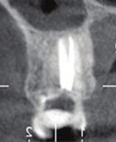 The present paper describes the nonsurgical endodontic management of an unusual maxillary first molar with two roots.