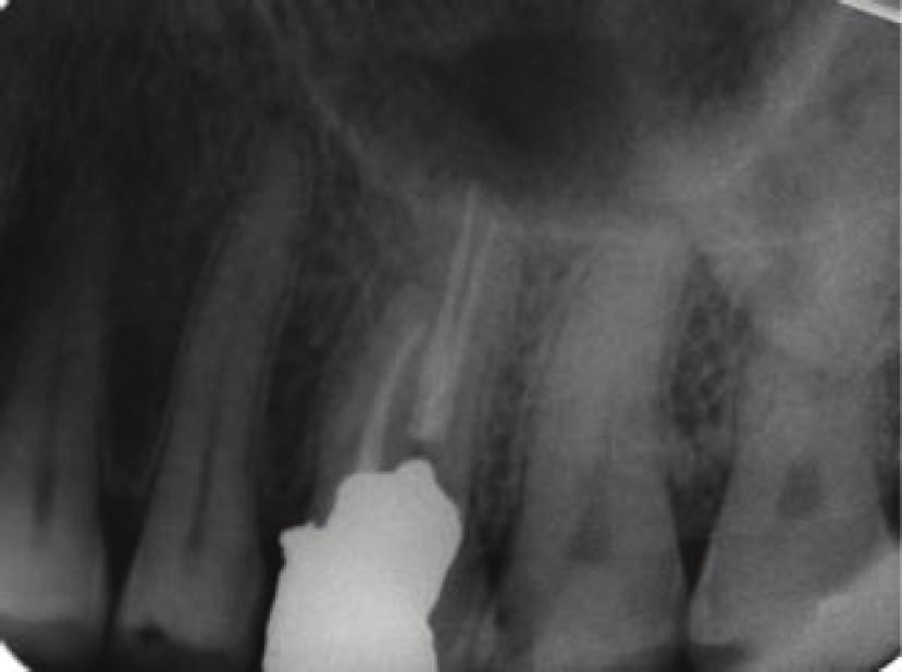 (2006) conducted a comprehensive review of the root and root canal morphology of the maxillary first molar [2].