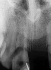 Root canal therapy or regeneration should be performed only at subsequent follow up visits should the vitality tests yield negative results or the tooth exhibits resorption. Figure 1.