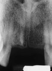 RCT had been performed subsequent to replantation, yet complete root resorption had occurred An avulsed tooth that that has been out of the socket for more than one hour and allowed to become