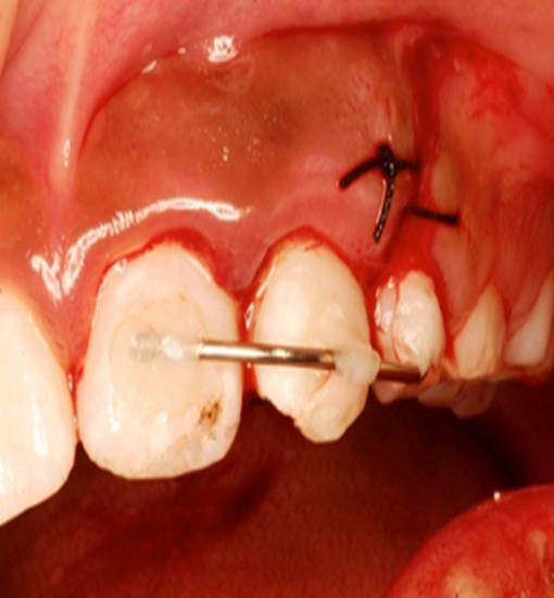 Mature teeth with more than 3mm and immature teeth with more than 7mm intrusion, should be repositioned surgically or extruded orthodontically within 3 weeks Figure 5.