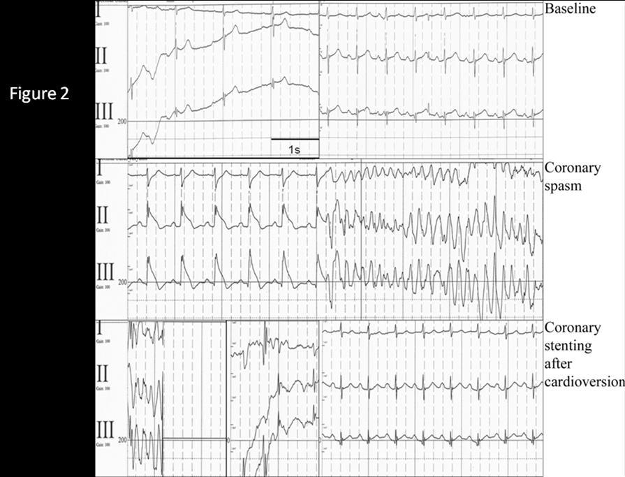 The more likely cause of ST-segment elevation in this case was coronary spasm.