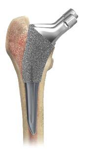 Extensive size range The Tri-Lock Bone Preservation Stem system features 13 stem sizes, allowing the surgeon