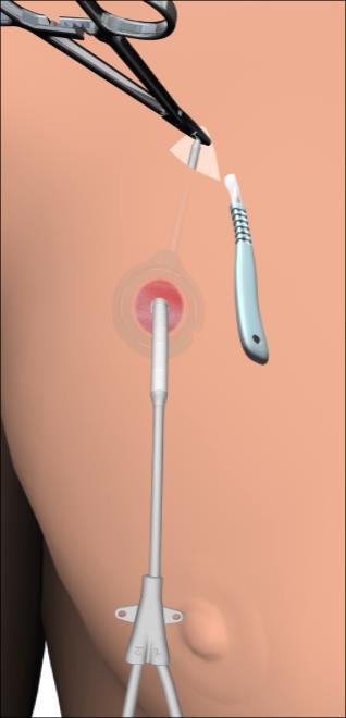 Catheter Removal The NexSite HD device is designed to facilitate skin healing at the catheter exit site.