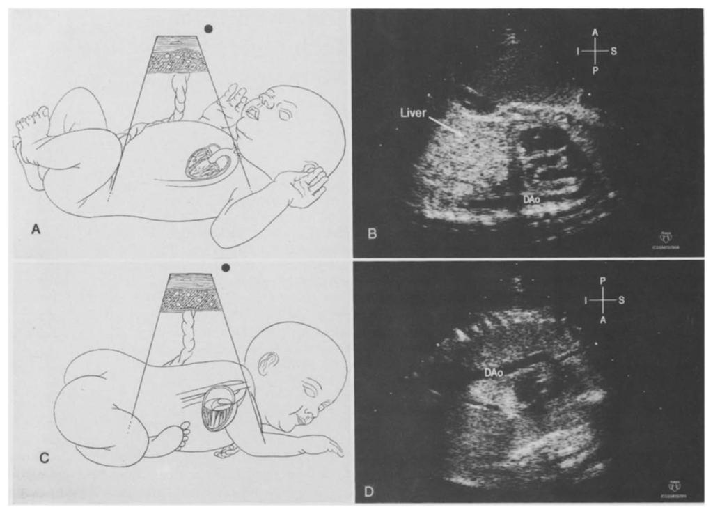 Transducer is oriented so that fetal head is to right side of video screen. Fetal anterior (A) /posterior (P), superior (S) I inferior (I), and left (L) I right (R) axis' are identified.