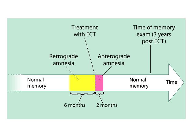 Timing of Anterograde and Retrograde Effects Retrograde