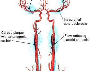 Atherosclerosis affects