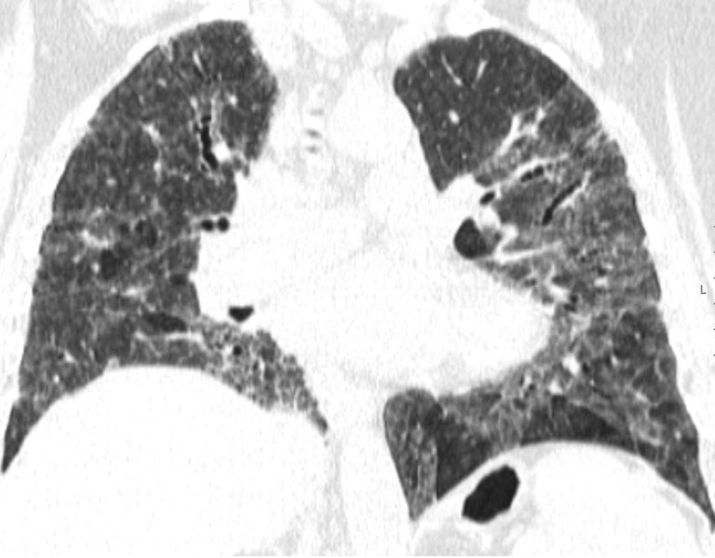Fig. 10: Reformatted coronal non-enhanced thoracic CT scan image showing fibrosis and traction bronchiectasis with a