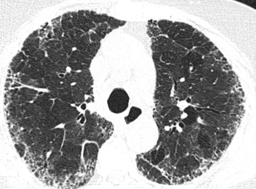 Fig. 11: HRCT scan image demonstrating diffuse peripheral honeycombing and some traction