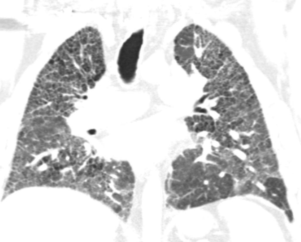 Fig. 12: 54 years old male with chronic HP and history of mold exposure.