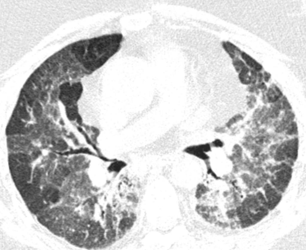 Fig. 3: HRCT scan demonstrates diffuse ground glass opacities in the middle part of both lungs, with a bronchovascular distribution.