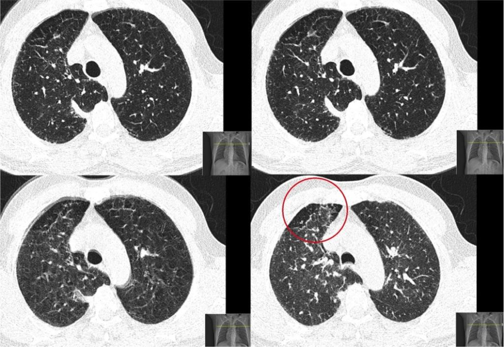 Fig. 5: Axial images of dynamic expiratory CT scan in a 42 years old patient with HP.