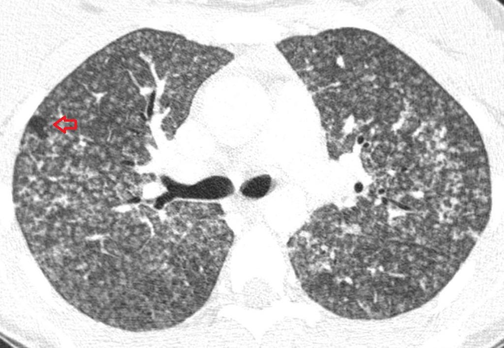 Fig. 6: 30 years old female with HP after exposure to mold.