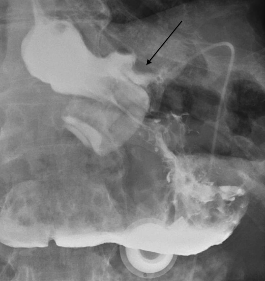 Fig. 7: Gastric band erosion. The gastric band now lies in the gastric lumen and contrast can be seen outlining outside the band (arrow).