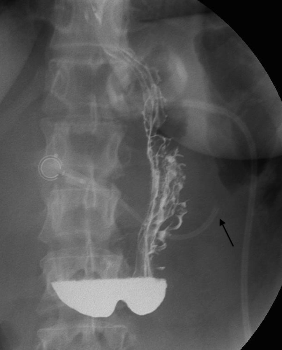 Fig. 10: Tube fracture. The tube connecting the gastric band and post has fractured (arrow).